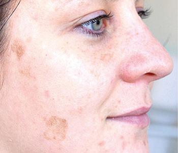 before and after green peel houston herbal treatment