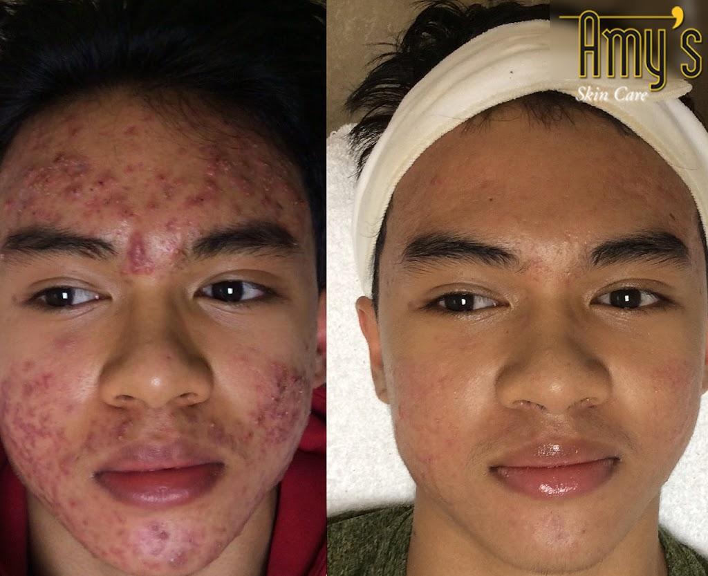 Acne Treatment Houston - Amy's Skincare & Med Spa