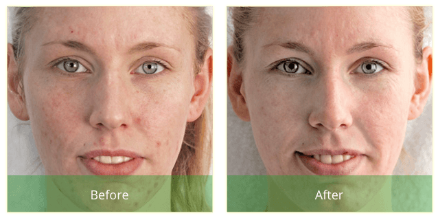 green-peel-houston-before-1.png green peel houston before 1